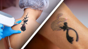 Qu'est-ce que l'élimination au laser des tatouages ?